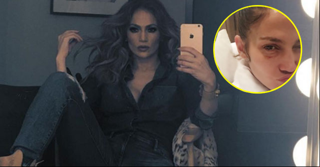 ¿Accidente? Jennifer López comparte foto con el ojo morado (+FOTO)